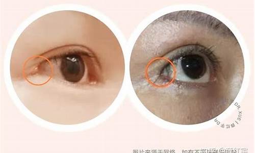 开外眼角眼白一层膜一推有褶皱(开了外眼角眼角起了一层膜)_https://www.czytfl.com_期货_第1张